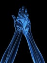 X-ray hands - arthritis