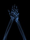 X-ray hands - arthritis