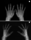 X-ray of hands. Arthritis-arthrosis. Royalty Free Stock Photo