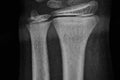 x-ray of the hands, detail of the phalanges and joints,trapeze,scaphoid,Pyramidal,Pisiform,capitate, distal, frontal, proximal,