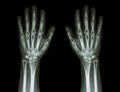 X-Ray Hands ( front view ) : Normal human hands