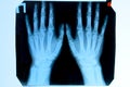 X ray of the hands, a picture of the bones of the hands on the x-ray Royalty Free Stock Photo