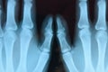 X ray of the hands, a picture of the bones of the hands on the x-ray Royalty Free Stock Photo