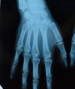 X ray of the hands, a of the bones of the hands on the x-ray Royalty Free Stock Photo
