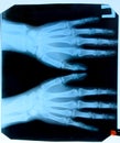 X ray of the hands, a of the bones of the hands on the x-ray Royalty Free Stock Photo