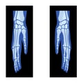 X-Ray Hands with Radius, Ulna Skeleton Human body, Bones adult people roentgen side view. 3D realistic flat blue color