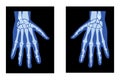 X-Ray Hands Skeleton Human body, Bones adult people roentgen back view - Metacarpals, Phalanges 3D realistic flat blue