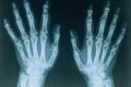 X-ray of hands. Two hands, X-ray close-up, front projection