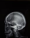 X-ray of head Royalty Free Stock Photo