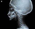 X ray of head showing part of neck. Royalty Free Stock Photo