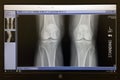 X-Ray of 2 healthy knee bones on a computer screen