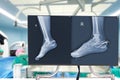 X-ray heel bone fractureCalcaneus fracture which is treated by surgery Blurry Traumatology orthopedic surgery hospital operating