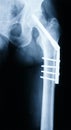 X-ray of a Hip Royalty Free Stock Photo