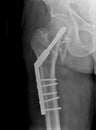 X-ray Hip AP