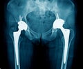 Bilateral hip replacement