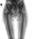 X-ray of hip child Royalty Free Stock Photo