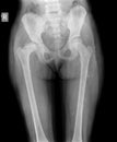 X-ray of hip child Royalty Free Stock Photo