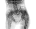 X-ray of hip Royalty Free Stock Photo