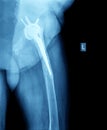 X-ray of hip prosthesis Royalty Free Stock Photo
