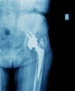 X-ray of hip prosthesis