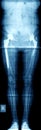 X-ray of hip prosthesis Royalty Free Stock Photo