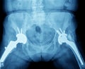X-ray of hip prosthesis Royalty Free Stock Photo