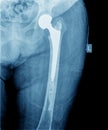 X-ray of hip prosthesis Royalty Free Stock Photo