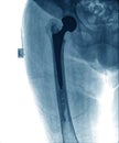 X-ray of hip prosthesis Royalty Free Stock Photo