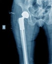 X-ray of hip prosthesis Royalty Free Stock Photo