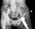 X-ray of hip prosthesis Royalty Free Stock Photo