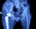 X-ray of hip prosthesis Royalty Free Stock Photo