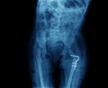 X-ray of hip prosthesis Royalty Free Stock Photo