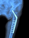 X-ray of the hip prosthesis Royalty Free Stock Photo
