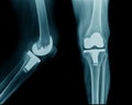 Knee joint replacement or TKA