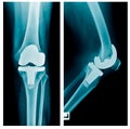 TKA knee joint x-ray Royalty Free Stock Photo