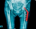 X-ray hip replacement Royalty Free Stock Photo