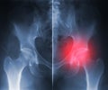 X-ray hip trauma Royalty Free Stock Photo