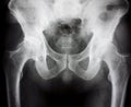 X-ray of the hips Royalty Free Stock Photo