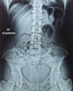 X-ray of human back spine radiography with digital imaging film display internal organ of woman patient`s health ribs, pelvis, h