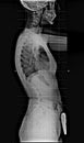 X-ray of human body, from chest to pelvis, complete spinal, kyphosis and lordosis, side view