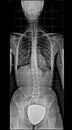 X-ray of human body, from chest to pelvis, complete spinal, scoliosis, front view Royalty Free Stock Photo