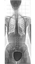 X-ray of human body, from chest to pelvis, complete spinal, scoliosis, front view Royalty Free Stock Photo