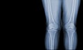 X-ray of human both knee standing views normal joints and ligaments Medical image concept Royalty Free Stock Photo