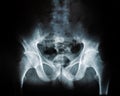X-ray of a human break hip coxal joint Royalty Free Stock Photo