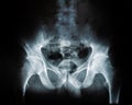 X-ray of a human break hip coxal joint