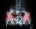 X-ray of a human break hip coxal joint Royalty Free Stock Photo