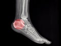 An x-ray of a human calcaneus fracture Royalty Free Stock Photo