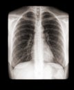 X-ray of a human chest front view Royalty Free Stock Photo