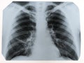 X-ray of a human chest or lungs radiography shot, medical techno