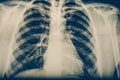 X-ray of a human chest or lungs radiography shot, medical technology and roentgen clinic diagnostic concept